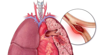 警惕肺部“無聲的致命一擊”——肺源性猝死