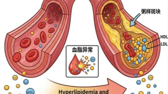 血脂“正常”就停藥？您的“正常”可能并不安全