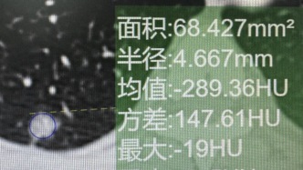 5mm肺結(jié)節(jié)觀察7年沒(méi)事，第8年突然惡化！磨玻璃結(jié)節(jié)這3個(gè)危險(xiǎn)信號(hào)必須警惕