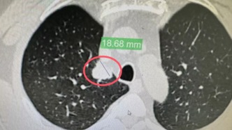 34mm混合磨玻璃結(jié)節(jié)8年不復(fù)發(fā)！熊貓血患者的肺癌手術(shù)奇跡