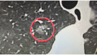 12mm纯磨玻璃结节随访1年无变化，术后竟发现是浸润腺癌