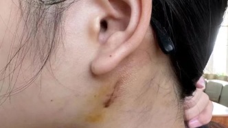 “你這個腫塊牽連神經(jīng)多，術(shù)后有可能面癱”
