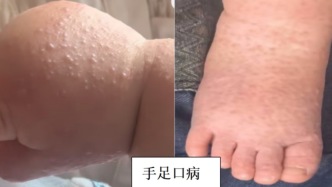 防病一张图：1分钟分清手足口病vs疱疹性咽峡炎，4步让娃不中招
