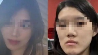 女子在医院做正颌手术后脸部歪斜，主刀医师：比之前洋气