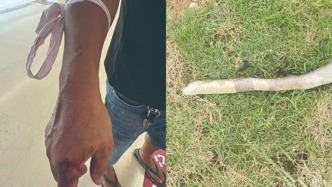 云南一男子驱赶眼镜蛇时被咬伤，徒手捉蛇到医院就医