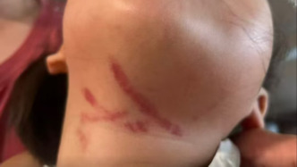 广东3岁女童遭幼儿园老师暴力喂食受伤，涉事教师已被拘留