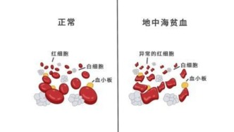 遗传率50%！这病南方高发，终身难治，从备孕到娃出生都要防