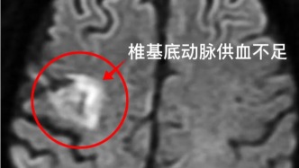 别等放支架才后悔！每天坚持这5个小习惯，血管一辈子不堵，省钱又省罪