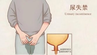 当“盆腔脱垂”来袭：我们该如何理性面对手术？