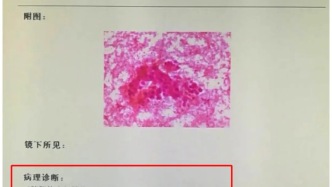 以为是上火，没想到竟是“癌王”！出现这4种症状千万别拖