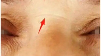 脸上出现这5种“异样”，可能是心脏出问题了，哪怕占一个也要留心