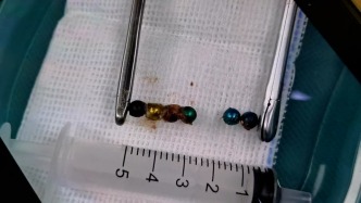 女童额头受伤做CT时意外发现鼻腔藏6颗磁力珠，医生手术取出