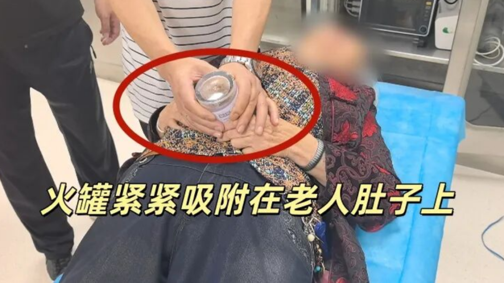 七旬老人“自助养生”险酿祸:用塑料罐拔火罐,吸住肚皮无法取下