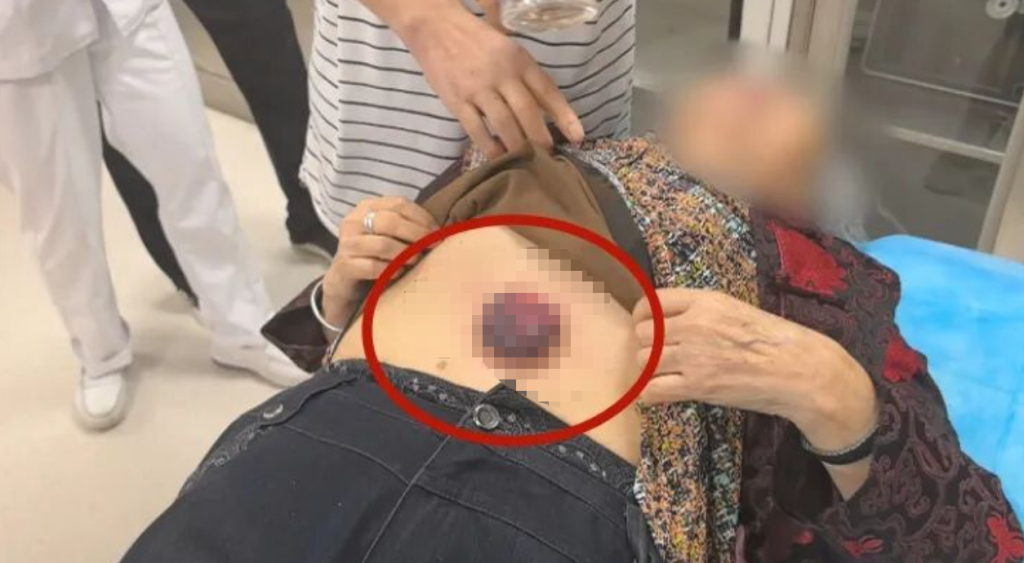 七旬老人“自助养生”险酿祸:用塑料罐拔火罐,吸住肚皮无法取下