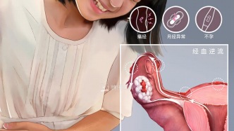 每次来姨妈都痛到打滚？可能是你的子宫内膜，跑错地方了