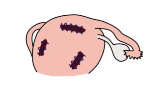 近10cm大肌瘤＋多发肌瘤，还想尽快生育：龚医生为什么选择三种术式联合？
