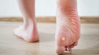 脚底长出的硬疙瘩，可能不是茧：一篇来自病理科的跖疣显微镜解读