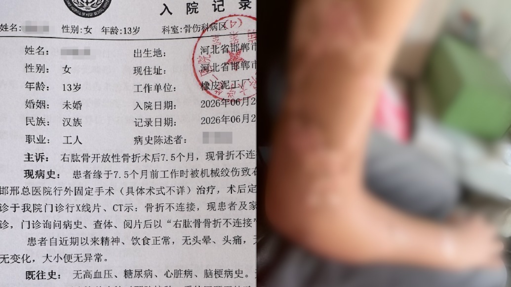 邯郸12岁女孩在橡皮泥黑作坊打工致6级伤残：厂方被判担责7成，监护人担责3成