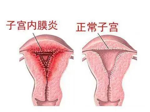 子宫内膜结核图片