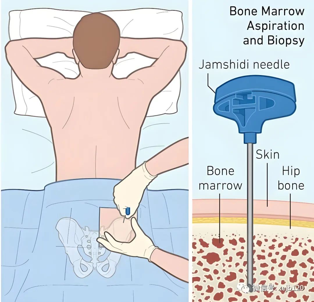 骨髓穿刺位置图解图片
