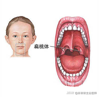 腭舌弓发红图片