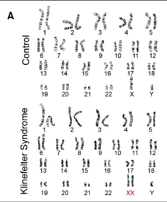 XXY染色体人的特征图片
