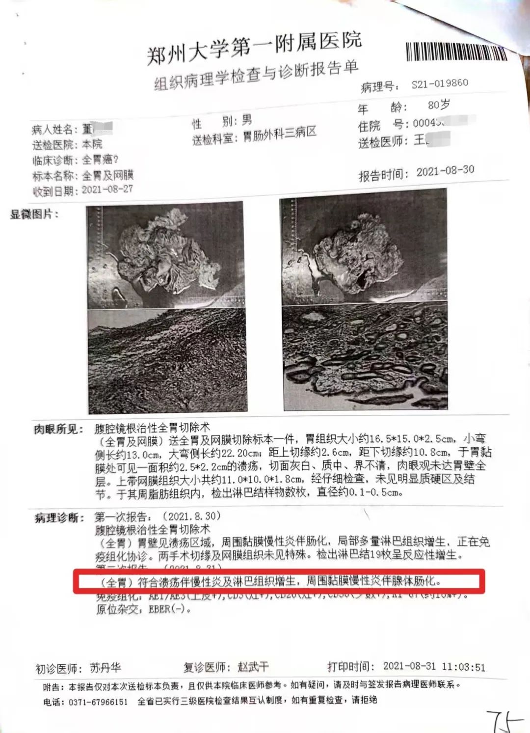 79岁老人患慢性胃炎,郑大一附院被指按胃癌晚期切除全胃