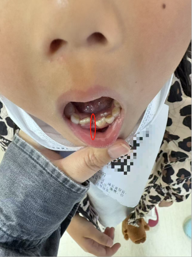 昆明7岁女童拔乳牙时被错拔恒牙,诊所:家长指定坚持要拔