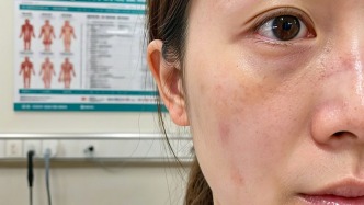 告别“小花脸”，科学战胜炎症后色素沉着