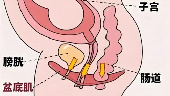 盆底与尿失禁健康革新：专利材料解密