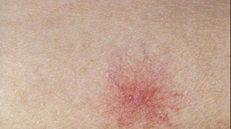 皮肤上的“小蜘蛛”是健康警报吗？