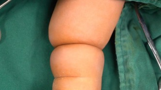 宝宝右腿像被“绳子”捆住，束带和婴儿肥一定要分清楚