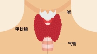 甲狀腺結(jié)節(jié)：了解這些，不再談“結(jié)”色變