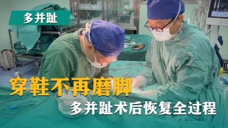 穿鞋不再磨腳，多并趾術(shù)后恢復(fù)全過程