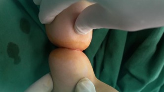 寶寶小腿腫成“葫蘆娃”，2個多月做緊急松解手術(shù)
