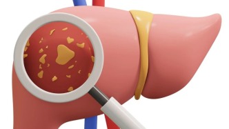 保胆取石术后必知：开启结石 “免疫” 模式