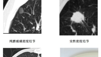 别怕肺结节！一文读懂其真相与处理方法