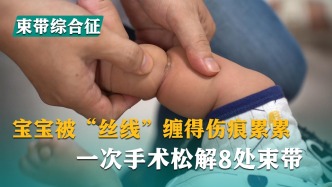 寶寶被“絲線”纏得傷痕累累，一次手術(shù)松解8處束帶