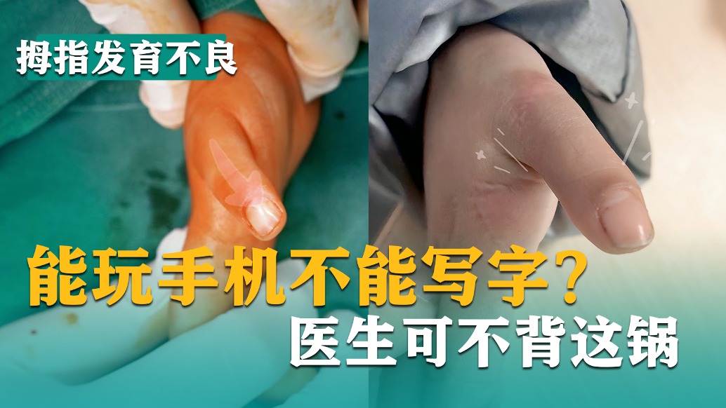 能玩手機不能寫字?醫(yī)生可不背這鍋