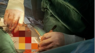 無法開口的患者VS不能停跳的心臟，這場“無聲手術”藏著多少生命密碼？