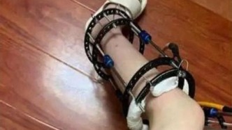 女子為增高13厘米花費60萬，卻換來一身后遺癥