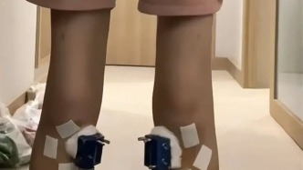 女子為增高竟接受斷骨手術，術后卻每天依賴止痛針度日