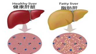 高原非酒精性脂肪性肝病：现代生活方式的隐形威胁