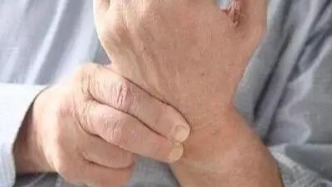 手腕部只要一活動就疼？警惕腱鞘炎來襲