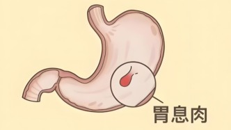 胃息肉，會變成胃癌嗎？哪些需要切除？有沒有辦法預防？