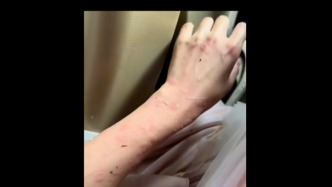 女演员拍戏被冰雹砸伤！高度警惕！这几天还有10级雷暴大风