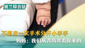 不植皮一次手术分开小手手，妈妈：我们从青岛奔着你来的