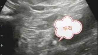 結(jié)石犯了，病人疼的直打滾！