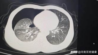 年輕帥哥深夜爆肺！別讓"顏值優(yōu)勢"變成健康隱患