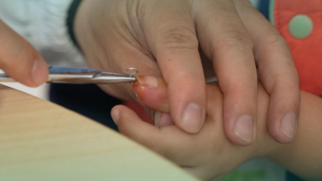 拔克氏針疼得汗都出來了吧,小孩哥:不是,我是熱的